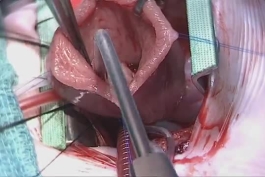 ❌ لطفا دلشو نداری نیا داخل!/ جراحی قلب اطفال (+ویدئو)