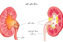 توصیه های تغذیه ای در بیماران مبتلا به سنگ کلیه :